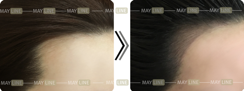 适合各种发型的纹发际线