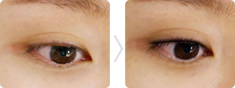 在掉色的眼线纹身上面做半永久美瞳线来修补眼线的顾客